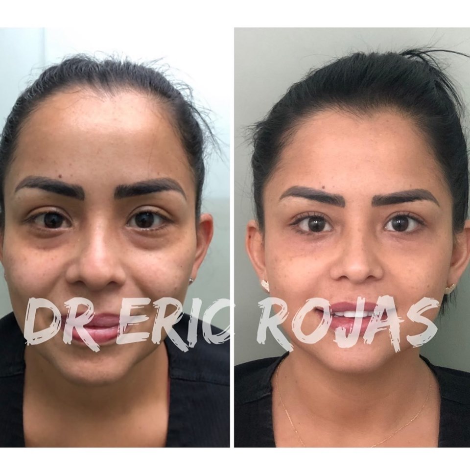 Ojeras, ya no más