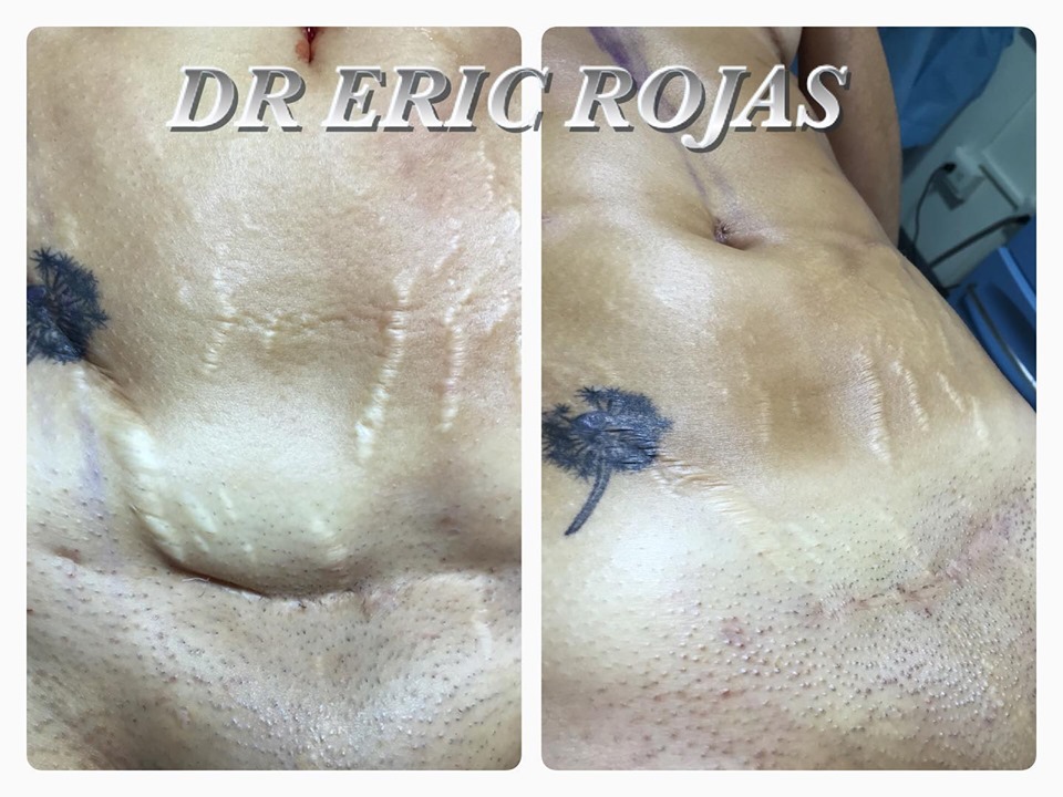 Decíle adiós a esa molesta cicatríz