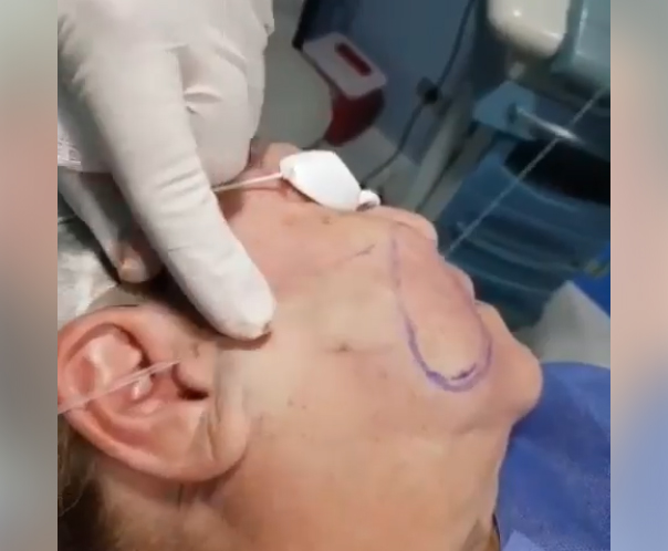 Tensado Facial SLIM LÁSER. ✅