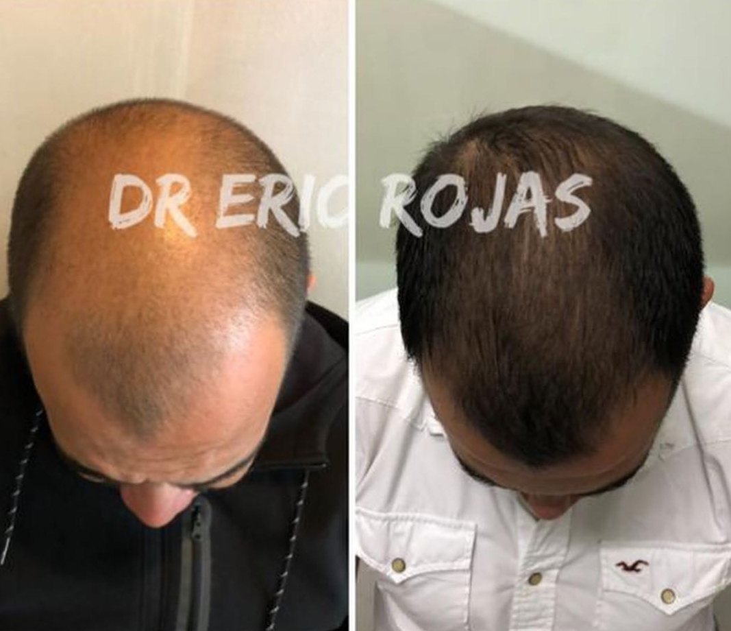 No pierda su cabello