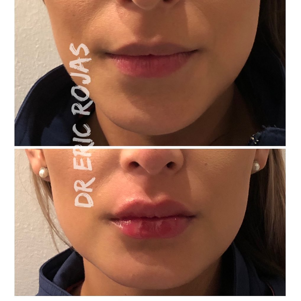 Modelado de labio