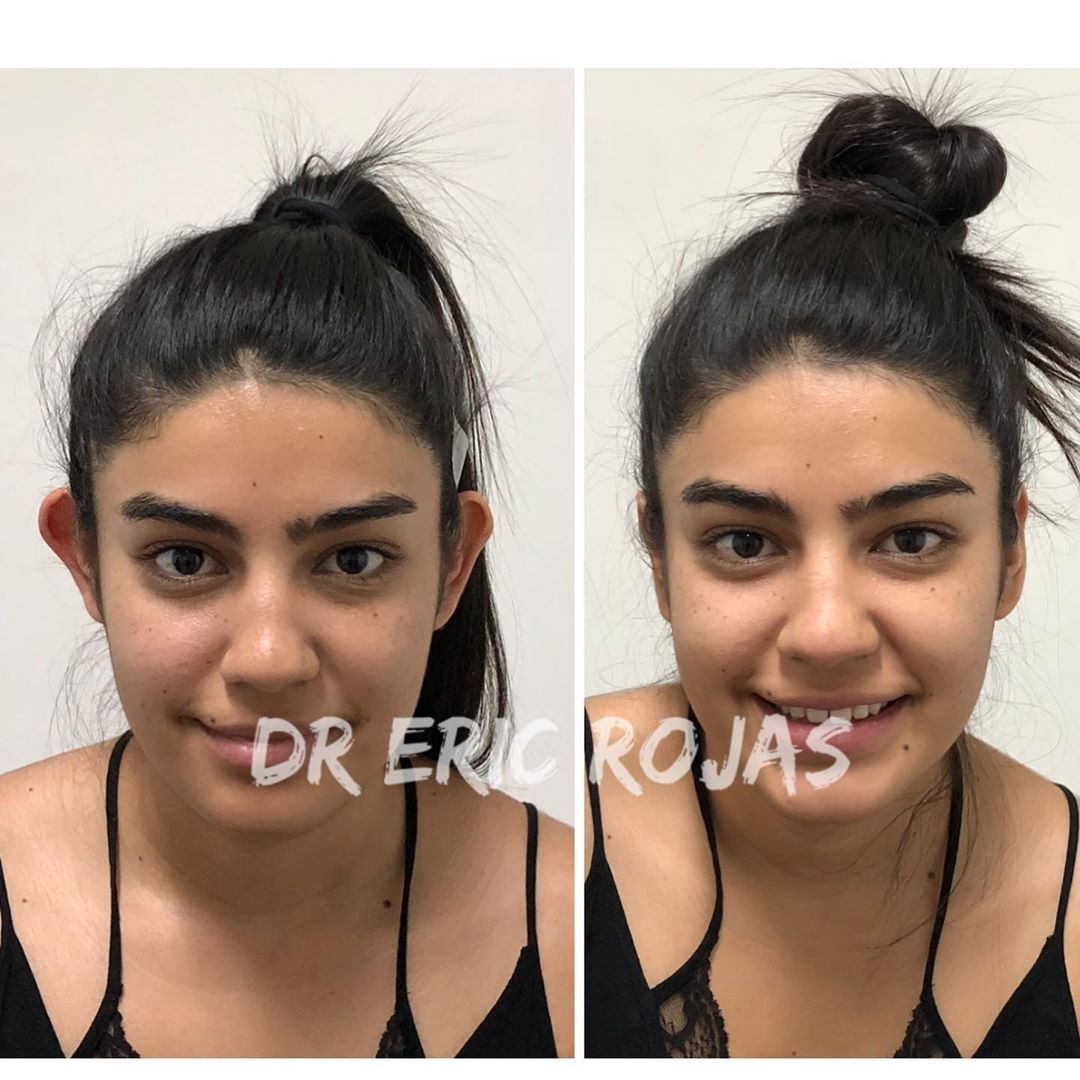 OTOPLASTIA DERMATOLÓGICA