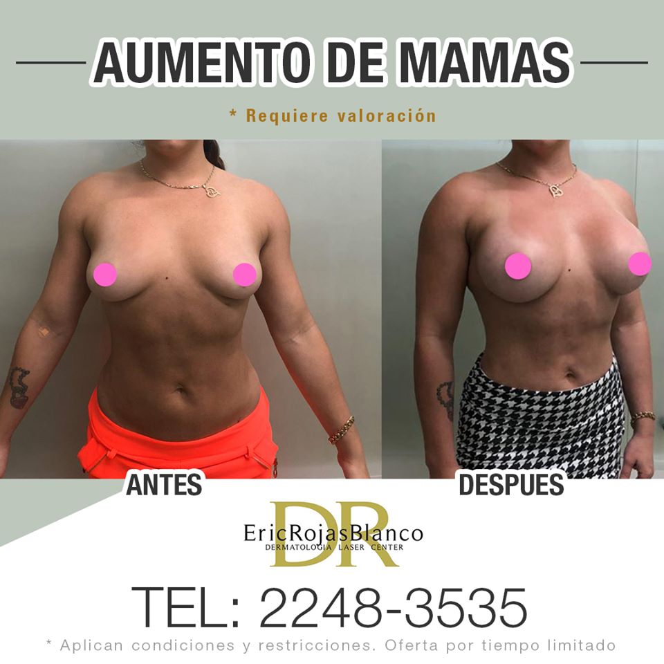 Aumento de mamas 👍