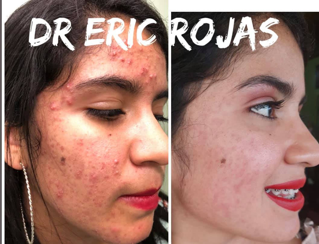 Tratamiento dermatológico integral para el acné