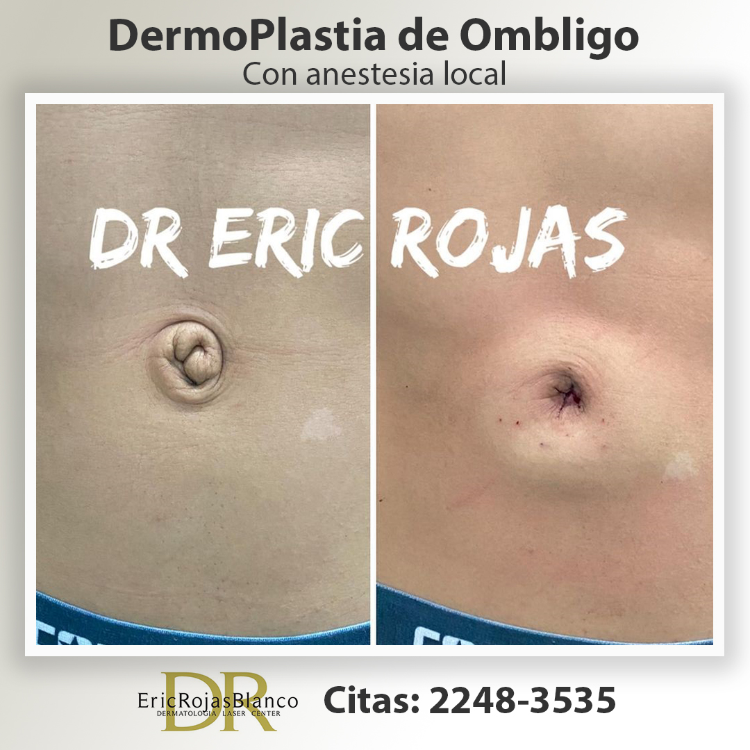 DermoPlastia de ombligo