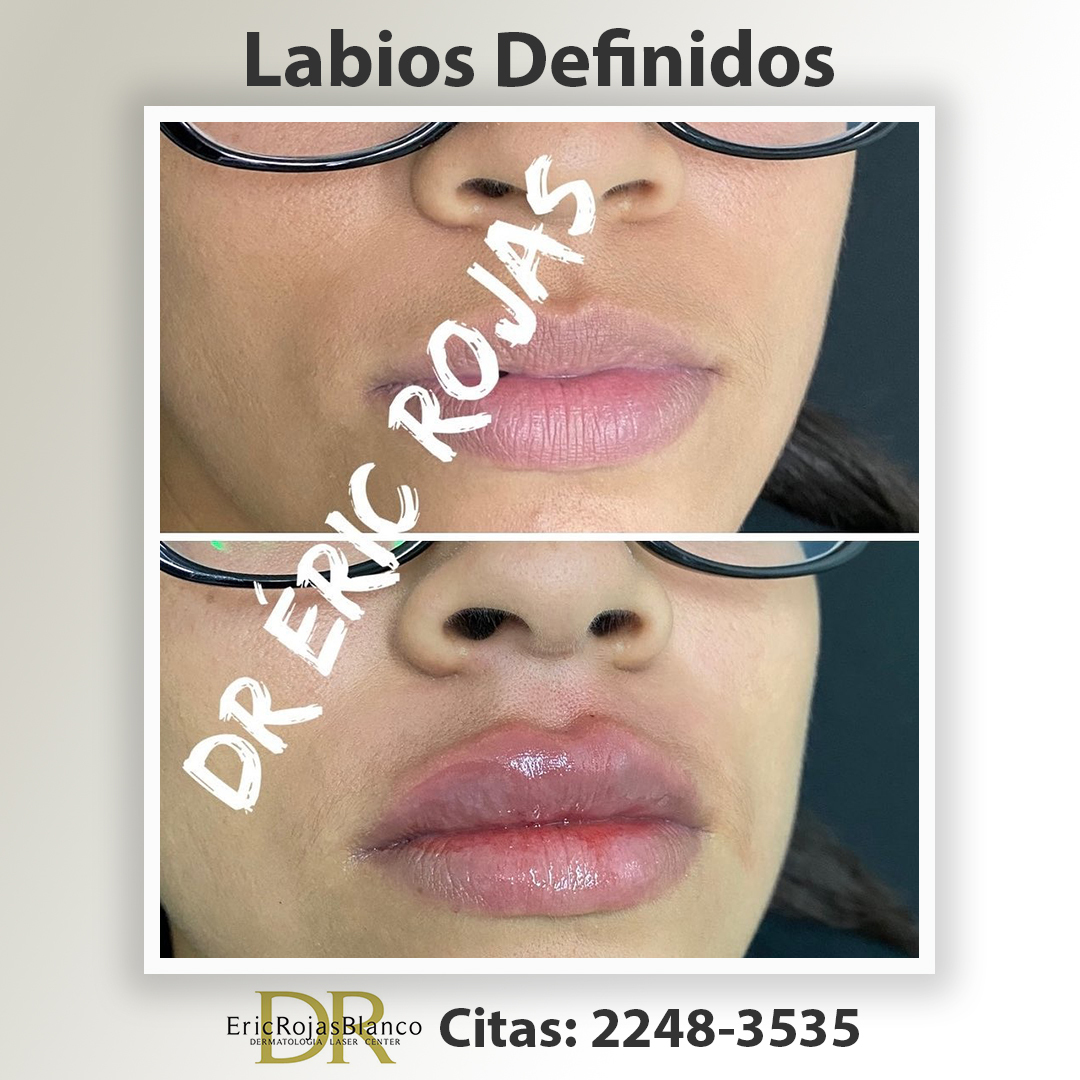 Corrección de Labios