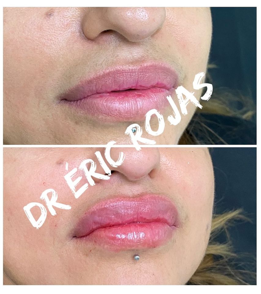 Corrección de labios.