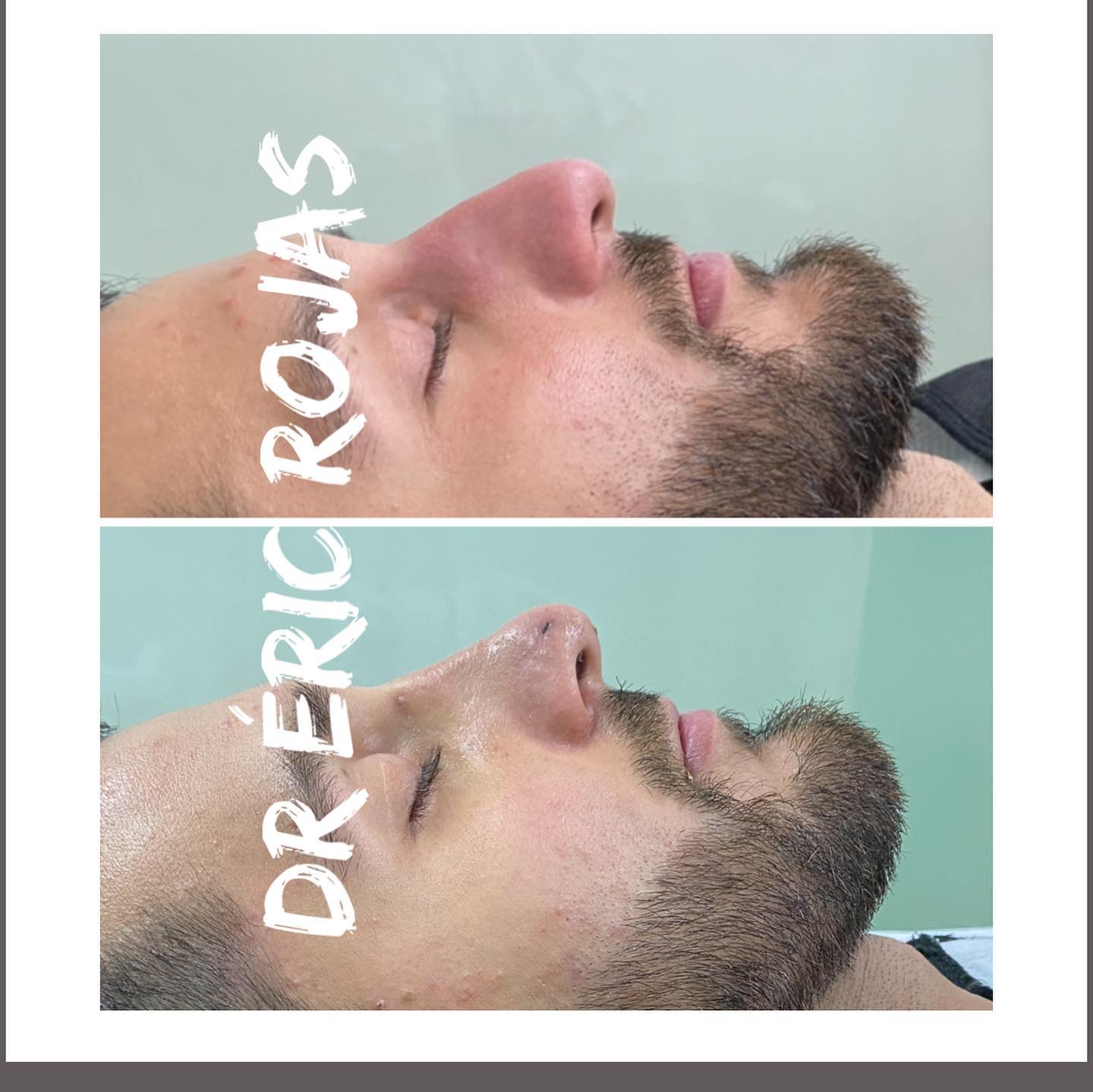 Perfil nasal corregido sin cirugía