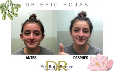 Corrección de orejas