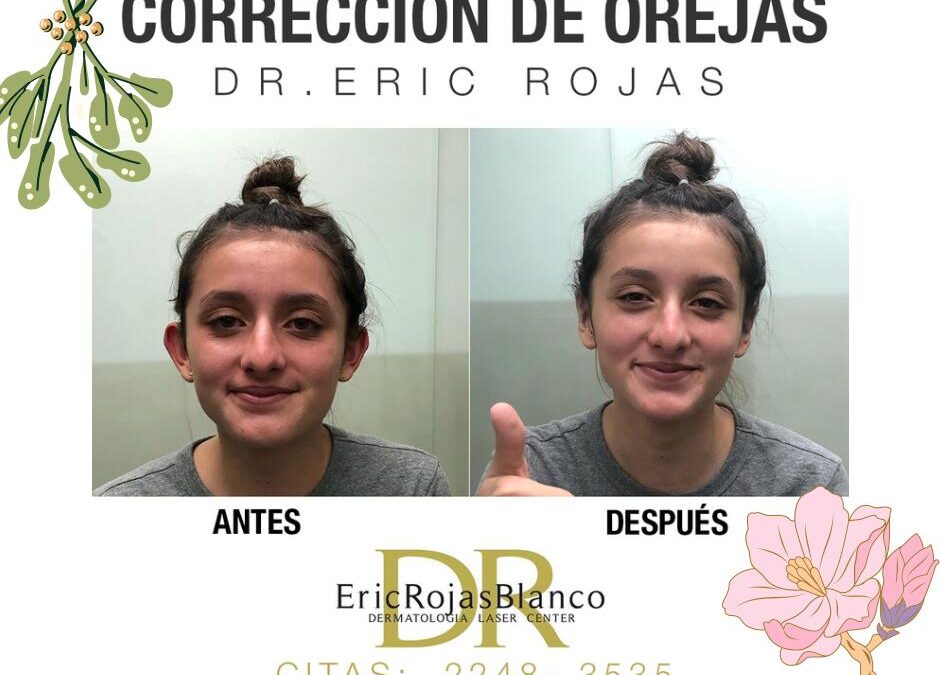 Corrección de orejas