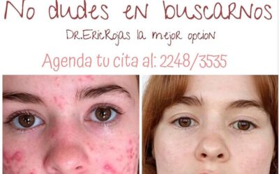 Tratamiento contra el acné 