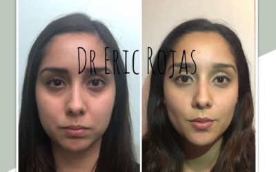 Perfilado Facial 