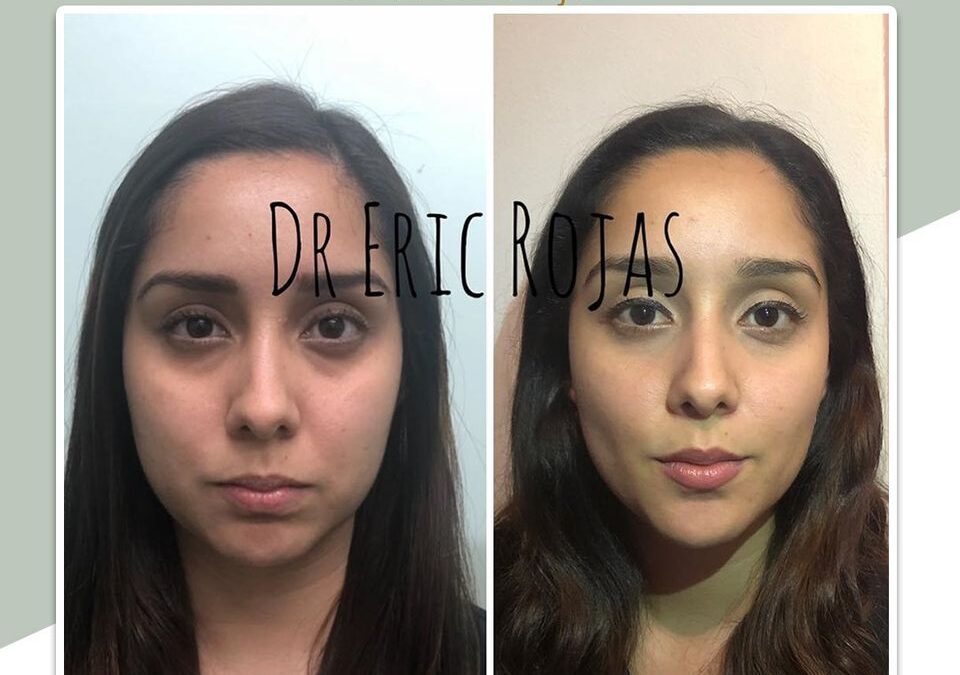 Perfilado Facial 