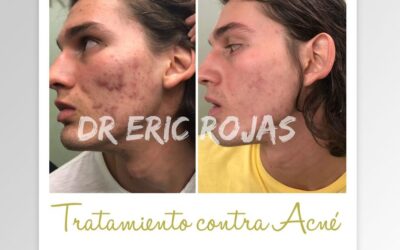 No mas problemas de acne.