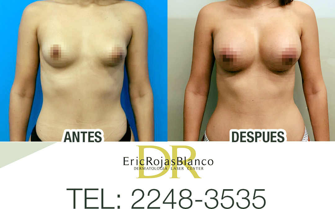  Implantes Mamarios DR. ERIC ROJAS 
