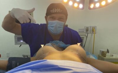 Implantes MAMARIOS