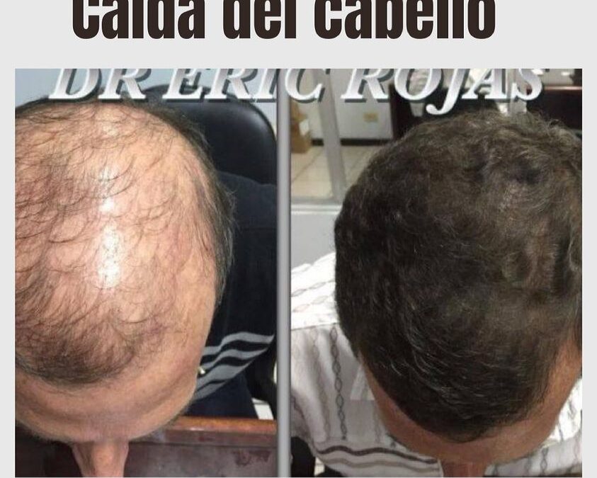 Pérdida del cabello.
