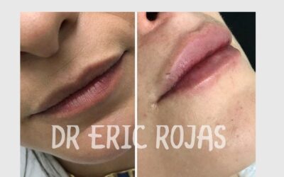 Relleno de labios