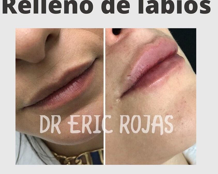 Relleno de labios