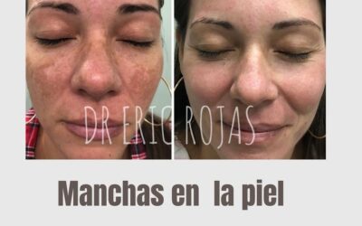 Ya no más manchas en la piel