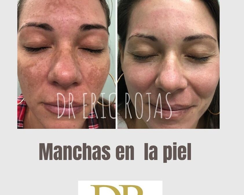Ya no más manchas en la piel