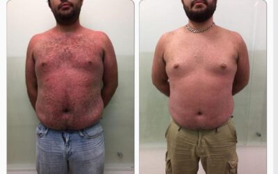 Ya no más Psoriasis