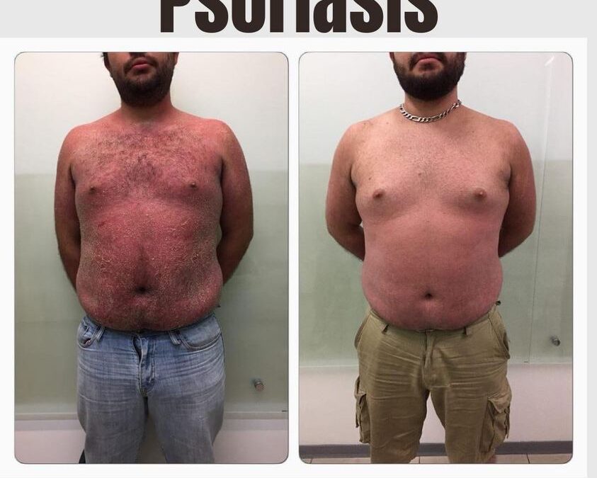 Ya no más Psoriasis