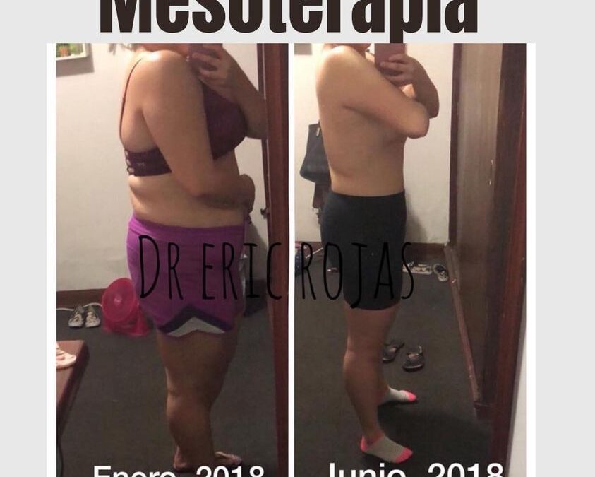 Mesoterapia