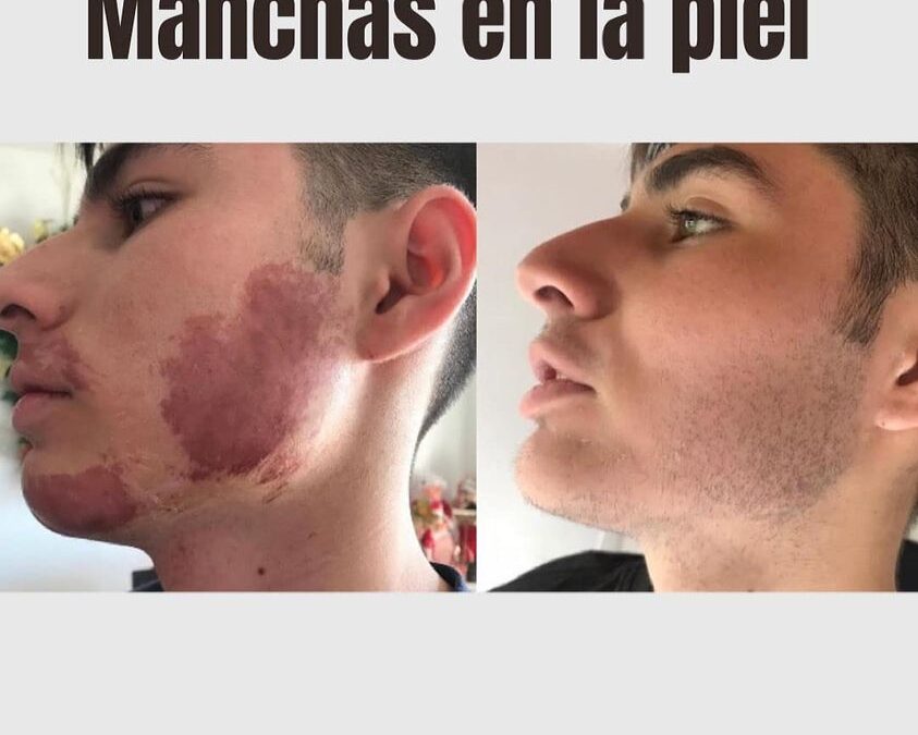 Tienes manchas en la piel que quieres eliminar ?