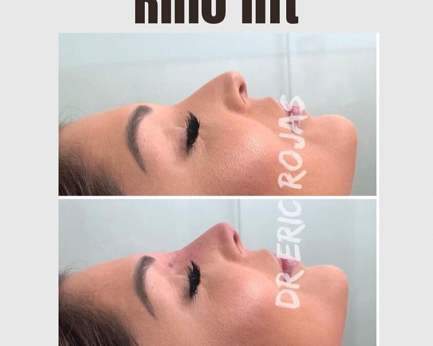 Rino lift