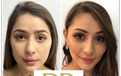 Perfilado Facial