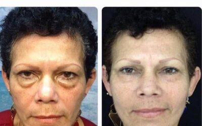 Rejuvenecimiento Facial
