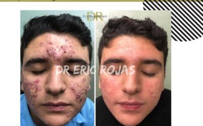 ¿Quiere eliminar el acné ?