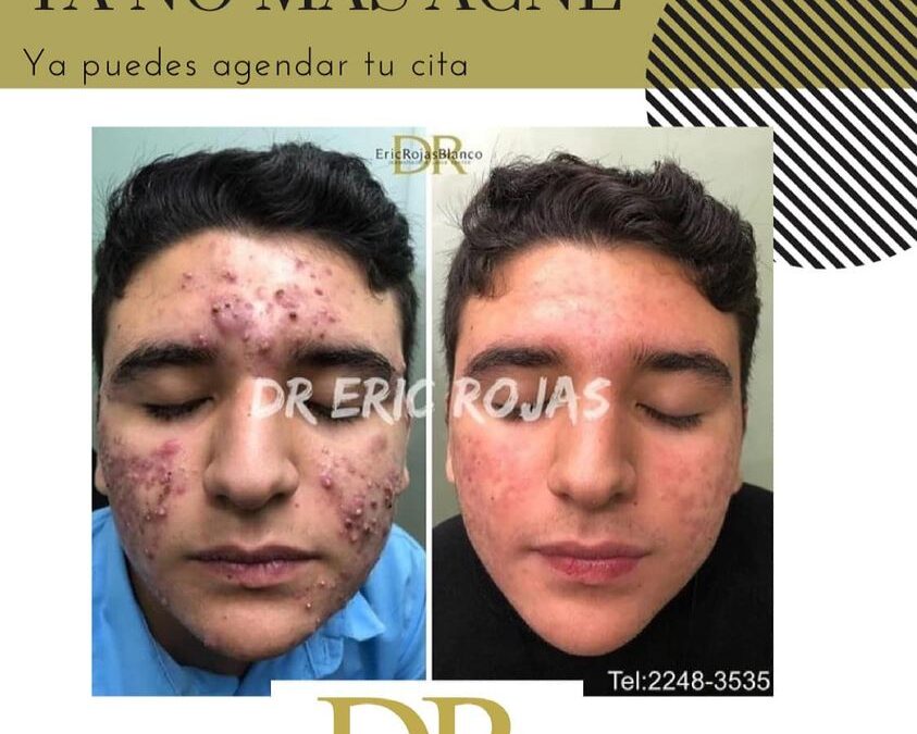 ¿Quiere eliminar el acné ?