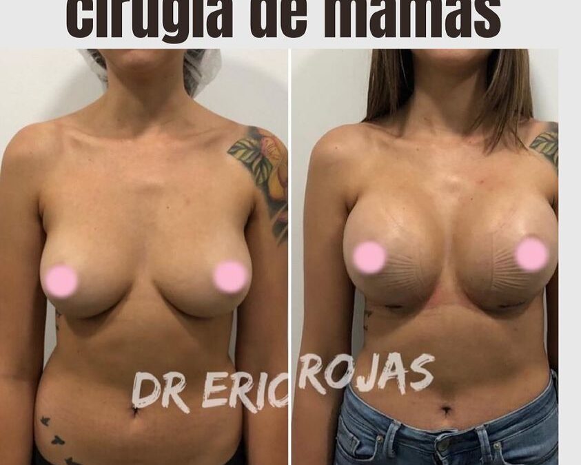 Cirugía de mamas