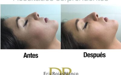 Quieres corregir tu nariz ?