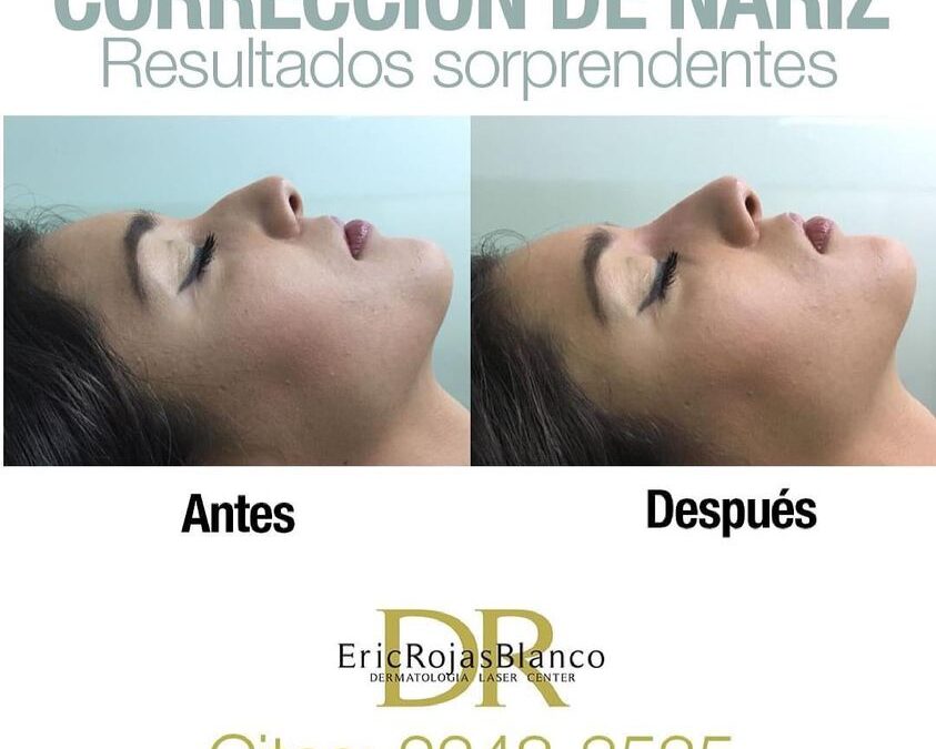 Quieres corregir tu nariz ?