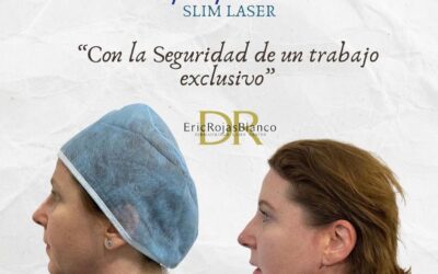 Corrección de papada