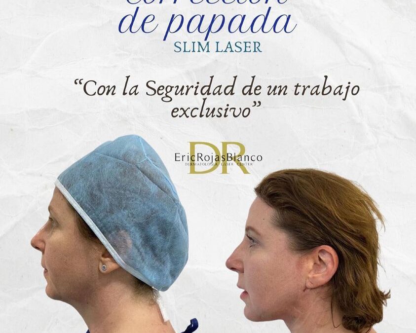Corrección de papada
