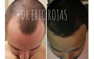 ¿Se te cae el cabello ?