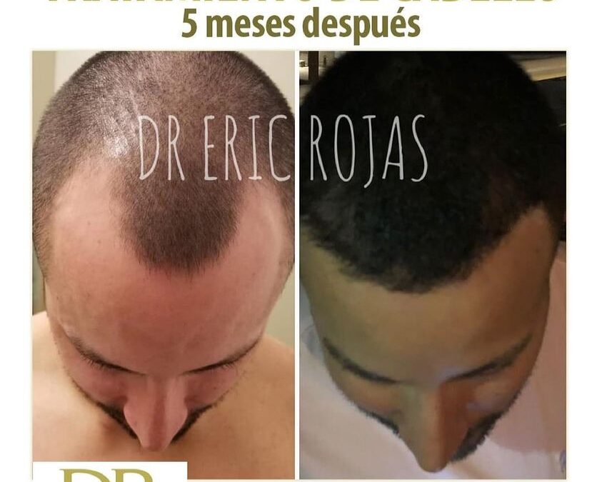 ¿Se te cae el cabello ?