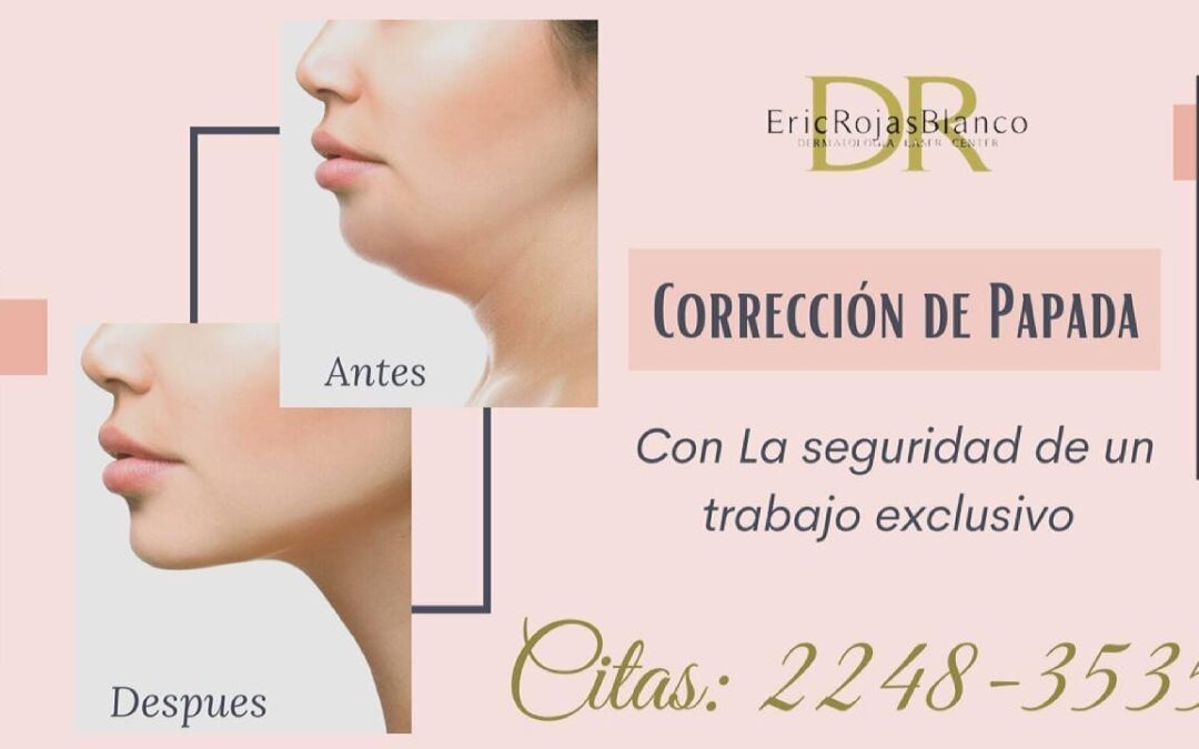 Corrección de papada