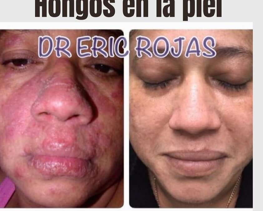 Hongos en la piel