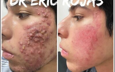 ACNE YA NO MÁS