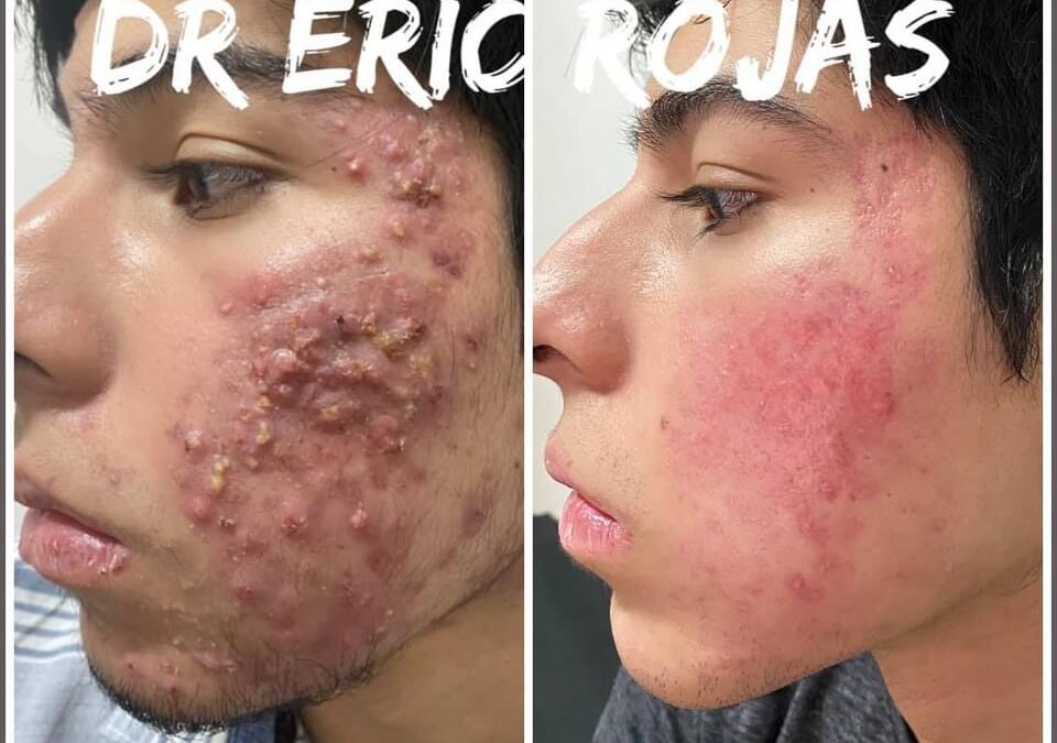 ACNE YA NO MÁS
