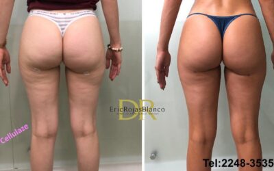 Trabajamos la celulitis