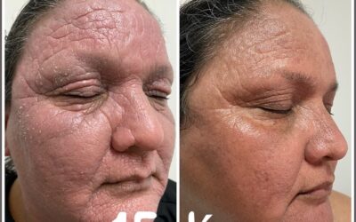 Dermatitis severa