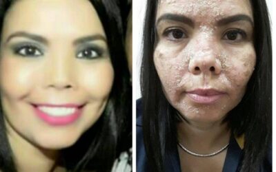 Eliminamos todo tipo de problemas en tu piel !