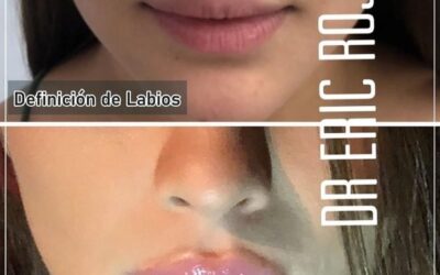 Relleno de labios