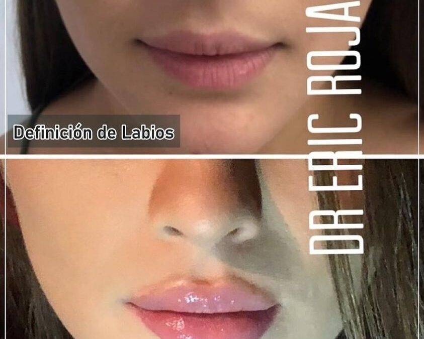 Relleno de labios